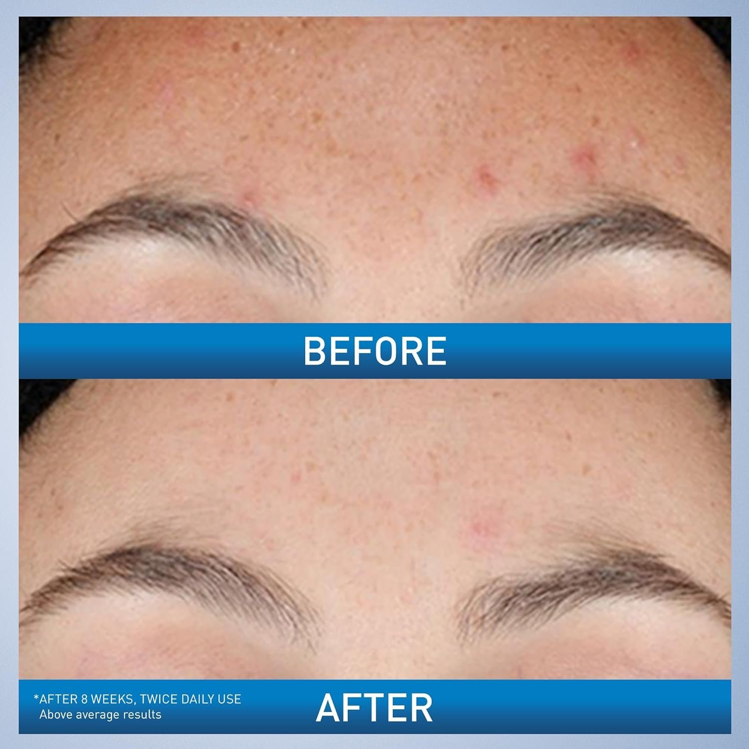 Cerave Resurfacing Retinol Serum For Post Acne Marks, Formulated... - Image 3