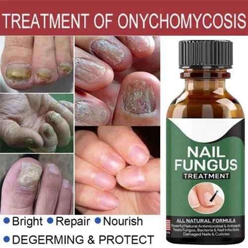 Fast Nail Fungal Treatments Nail Repair Essences Serum Care...