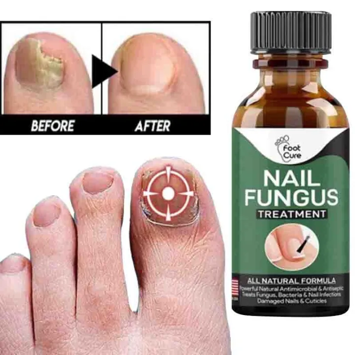 Fast Nail Fungal Treatments Nail Repair Essences Serum Care... - Image 4