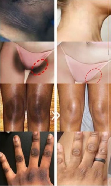 Whitening Cream For Sensitive Areas Underarm And Private Areas - 30G - Image 2