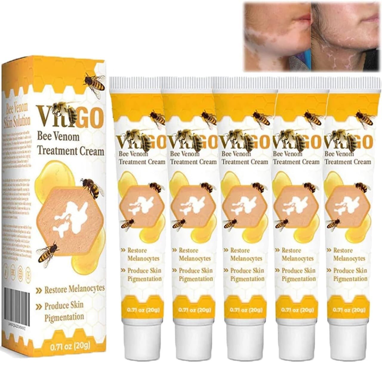 Fivfivgo™ Vitigo Bee Venom Correcting Cream (20g) Support for Skin