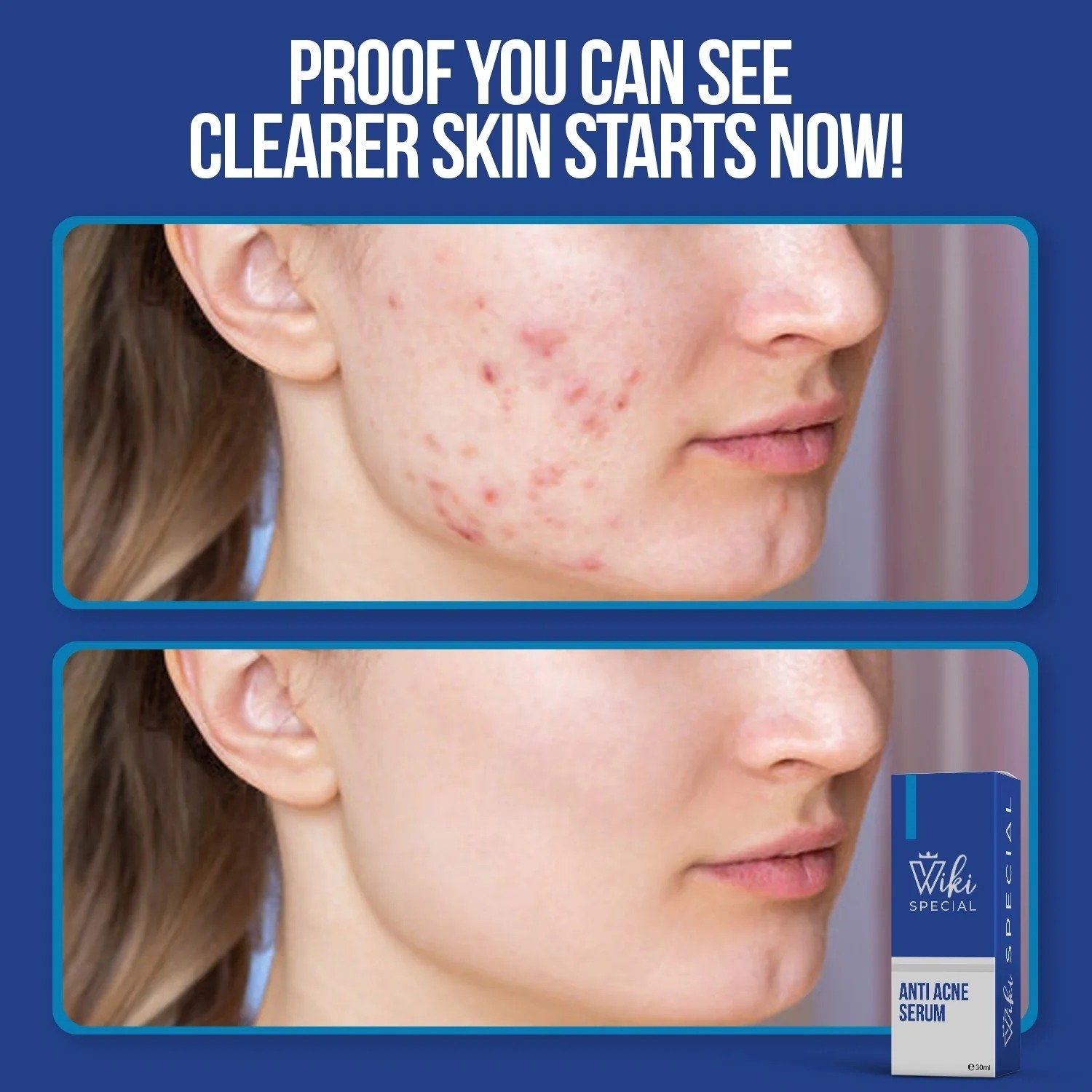 Wiki Special Anti Acne Serum - Image 3