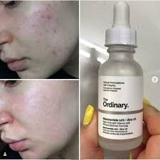 The Ordinary Niacinamide 10% + Zinc 1 % - 30Ml - Image 4