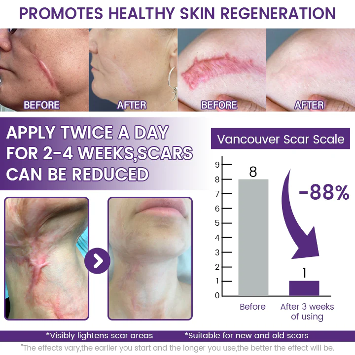 Timilk Regenscar Stem Cell Scar Gel 20g Triple Action Formula for Old - Image 2