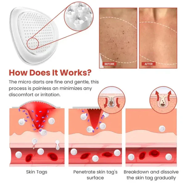 Dermasmooth Skin Tag Remover Patch - Image 3